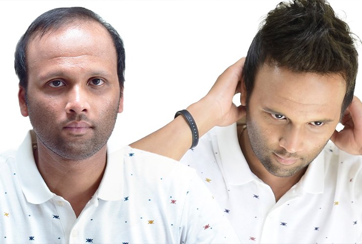 Non Surgical Hair Replacement In Mumbai - Hair Patch & Systems