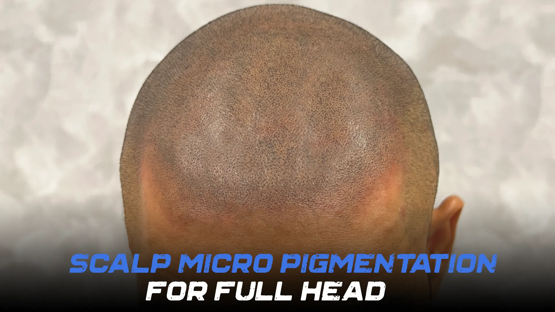 Scalp Micro Pigmentation Clinic For Full Head