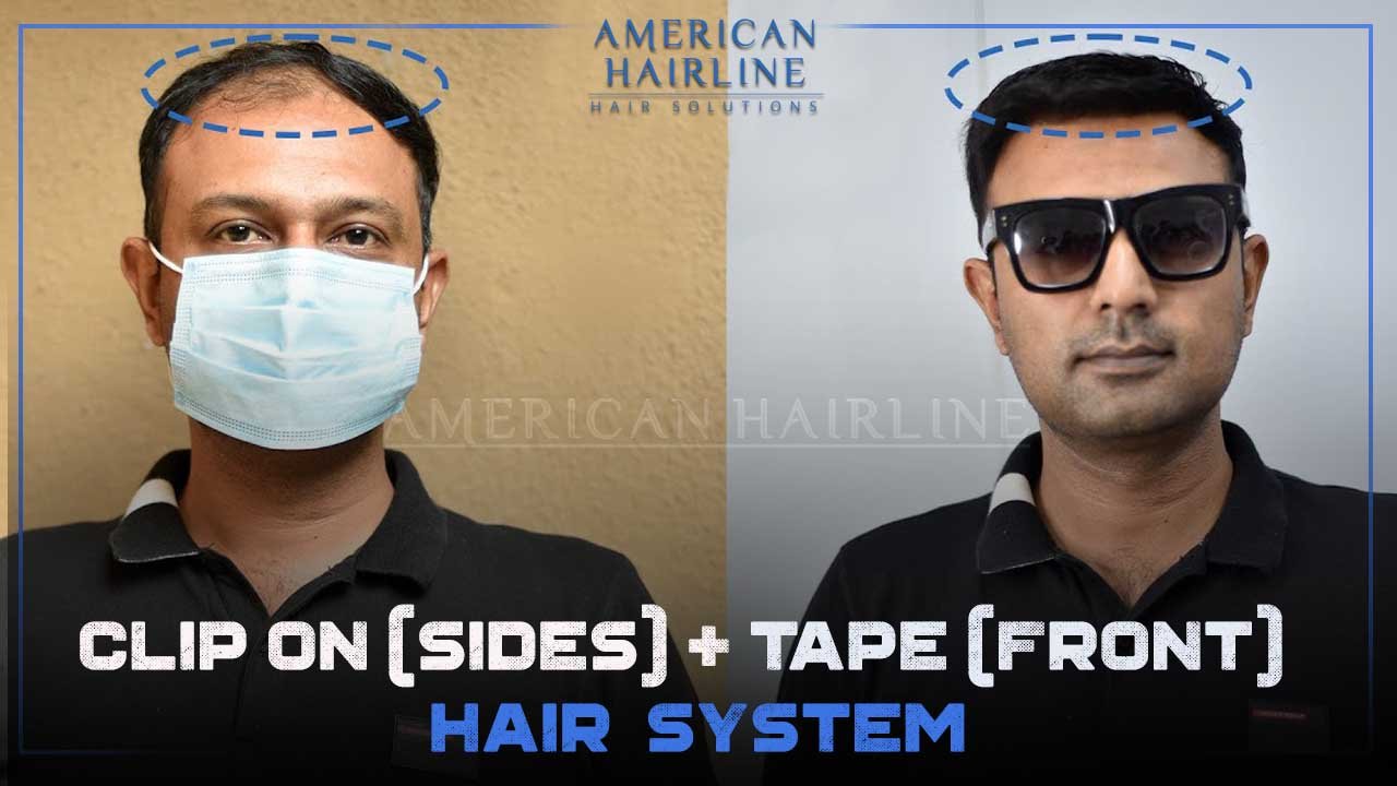 Side Clip-On & Front Tape Hair System for Men | Non-Surgical hair  Replacement in India
