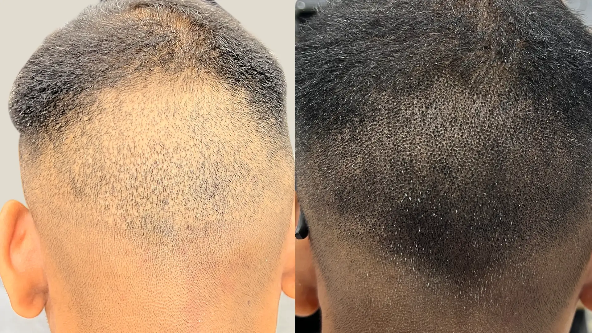 scalp micro pigmentation for men in india
